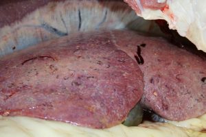 A liver with sub-acute fluke