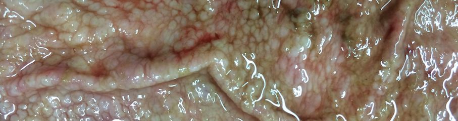 Ostertagia in the abomasum of a young cow