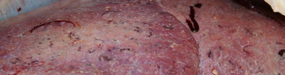 A liver with sub-acute fluke