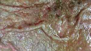 Ostertagia in the abomasum of a young cow