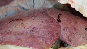 A liver with sub-acute fluke